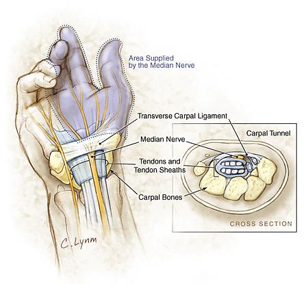 carpal tunnel pic